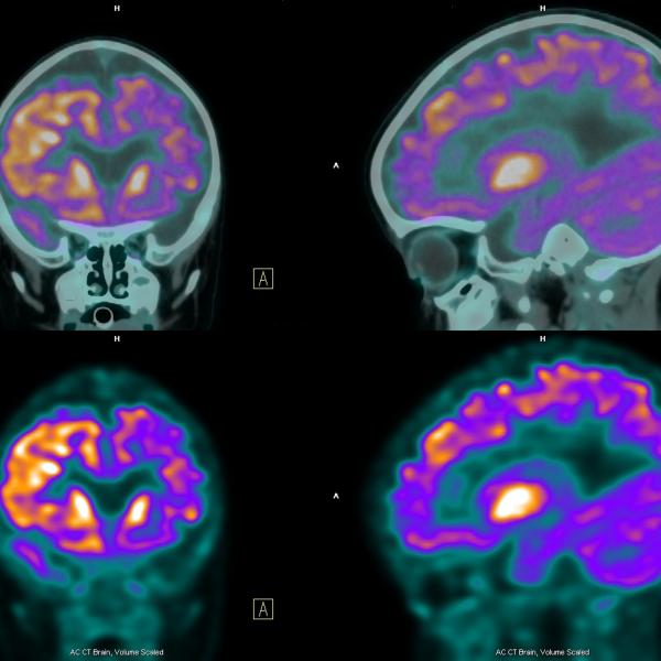 Nuclear medicine brain scans