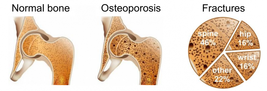 Osteoporosis is characterised by loss of bone strength  and changes to bone structure. After age 60, 1 in 2  Australian women will have a fracture related to  osteoporosis. Of all osteoporotic fractures in Australia,  almost half are vertebral (bones in the spinal column)  followed by fractures of the hip and wrist.